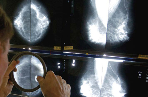 LOS ANGELES: A radiologist uses a magnifying glass to check mammograms for breast cancer in Los Angeles. — AP