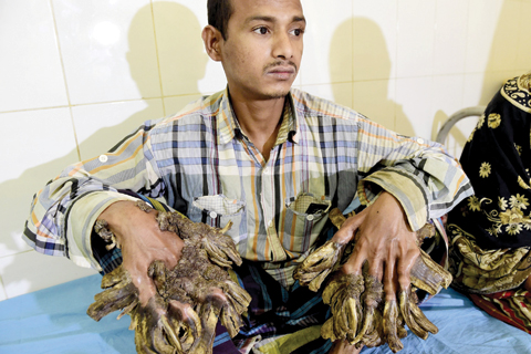 DHAKA: Bangladesh patient Abul Bajandar, 26, dubbed “Tree Man” for massive bark-like warts on his hands and feet, sits at Dhaka Medical College Hospital in Dhaka. — AFP