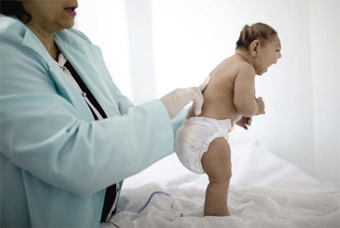 BRAZIL: Lara, who is less than three months old and was born with microcephaly, is examined by a neurologist at the Pedro hospital in Campina Grande, Paraiba state. — AP photos