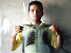 SONIPAT: Indian tuberculosis (TB) patient Sonu Verma, 25, poses with his chest x-ray in Sonipat. — AFP