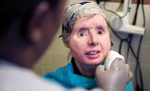 BOSTON: In this Feb 20, 2015 file photo, Charla Nash smiles as her care worker washes her face at her apartment. — AP