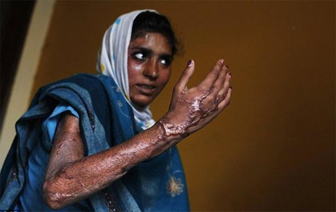 India woman attacked with acid for fifth time - AP