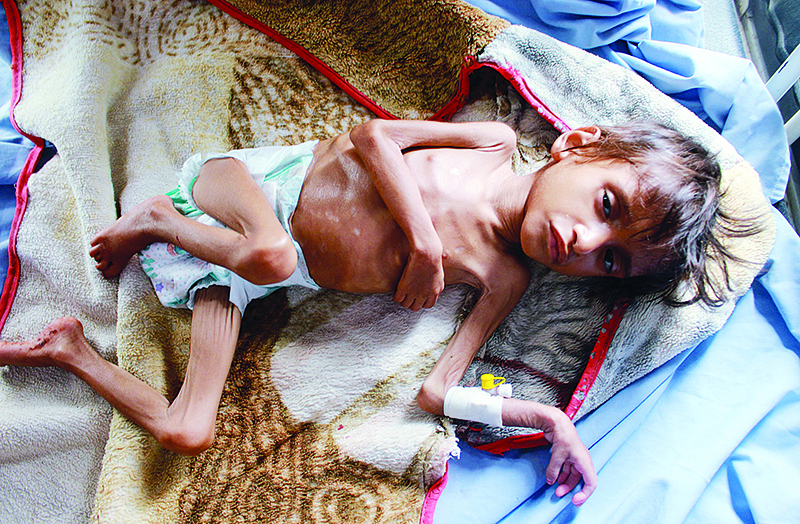 AL HAJJAH: A Yemeni child suffering from malnutrition lies in a bed at a treatment centre in Yemen’s northern Hajjah province. —AFP