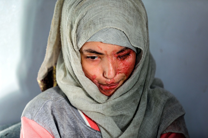 SANAA: Al-Anoud Sheryan, a 19-year-old girl disfigured in an acid attack by her abusive husband, sits at a hospital where she is undergoing treatment on Jan 28, 2021. – AFP n