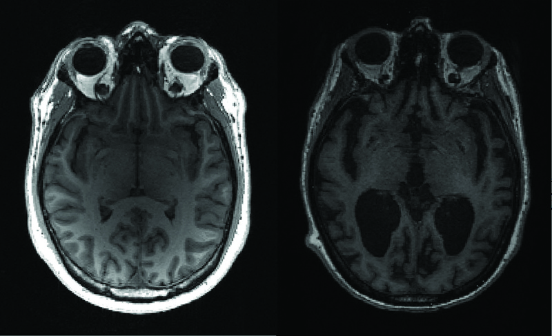 This undated image shows an MRI image of a healthy brain (left) and an Alzheimer's brain (right) with large black gaps where brain has shrunk. - AFP n