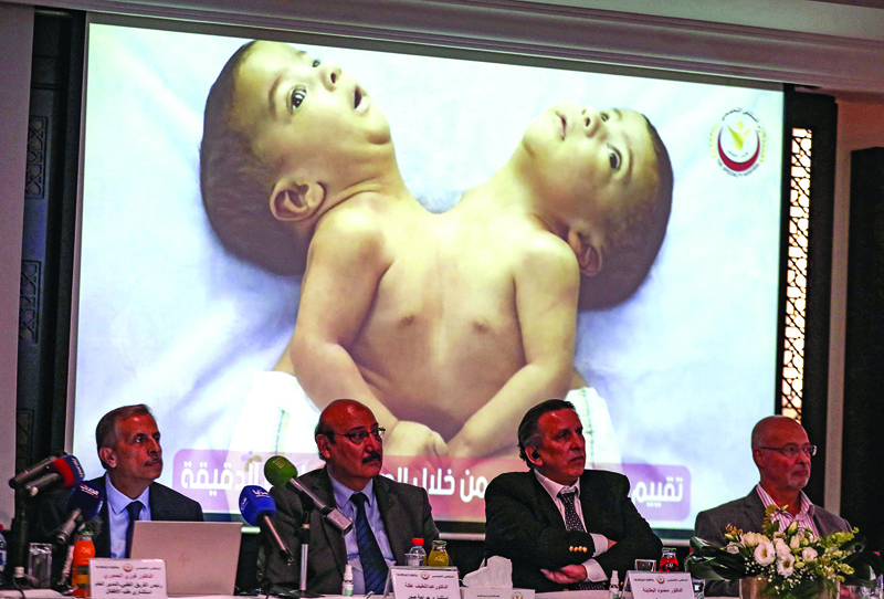 Members of a Jordanian medical team announce having performed a rare eight-hour operation to separate two Yemeni conjoined twins during a press conference in the Jordanian capital Amman, on October 3, 2021. - AFP n