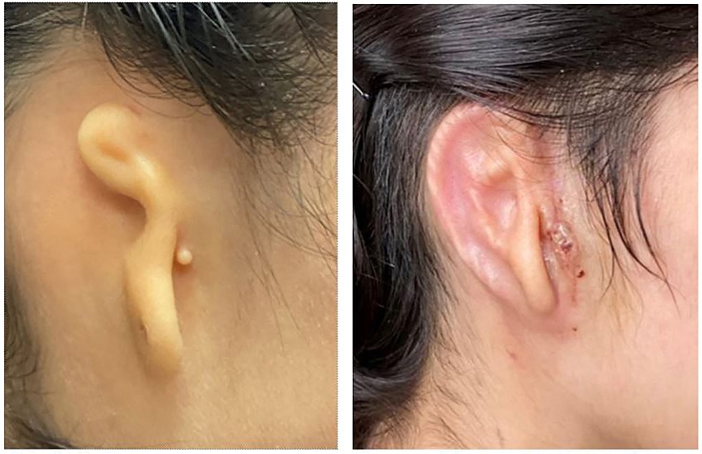 SAN ANTONIO: This May 31, 2022 image shows a before (left) image of a patient's ear and an image 30 days after surgery to reconstruct the earlobe. - AFP