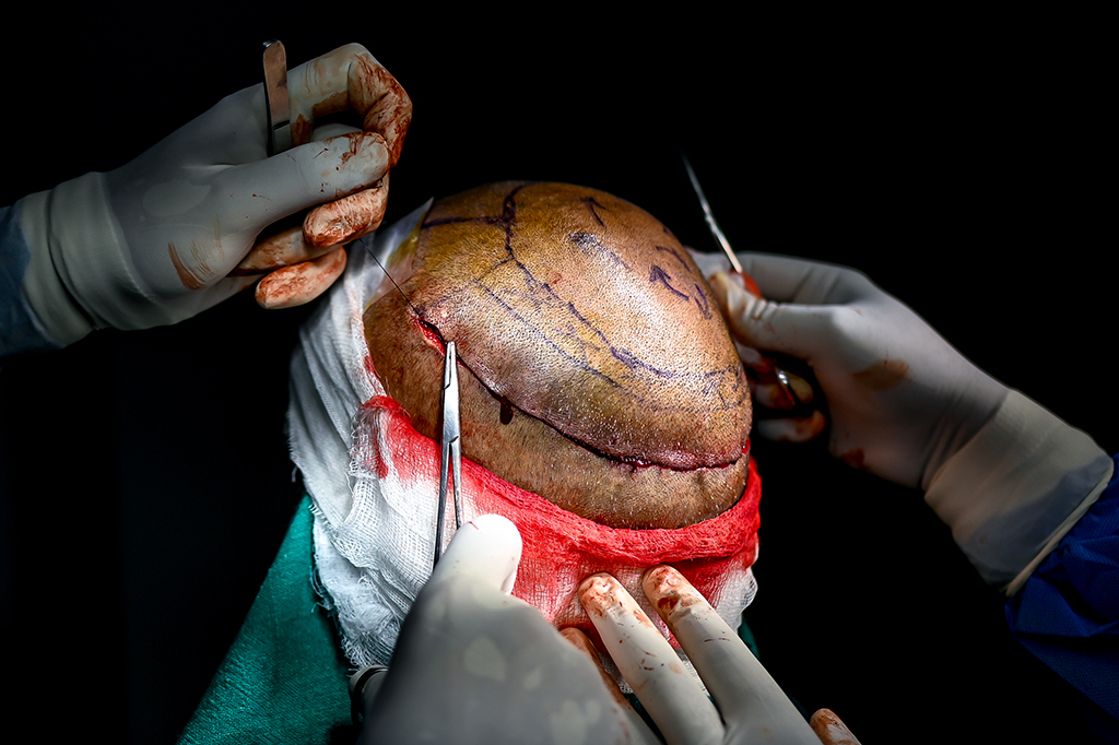 NEW DELHI: In this photograph taken on November 5, 2022, Dr Mayank Singh performs a hair transplant surgery at Crown hair transplant clinic in New Delhi. - AFP